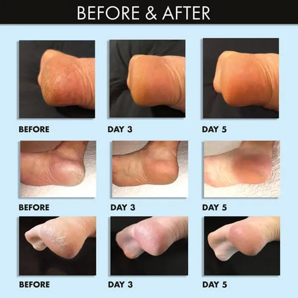 Coconut Milk   Verbena Exfoliating Foot Mask